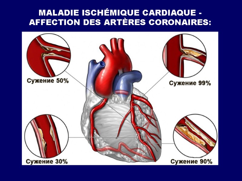 MALADIE ISCHÉMIQUE CARDIAQUE - AFFECTION DES ARTÈRES CORONAIRES: